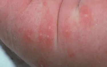 Dr. Yeung Ho Hong(楊浩康) explains Erythema Toxicum