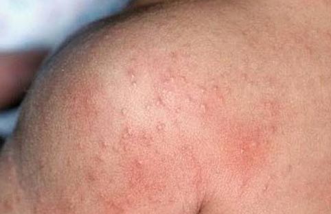 Dr. Yeung Ho Hong(楊浩康) explains Heat Rash/Prickly Heat
