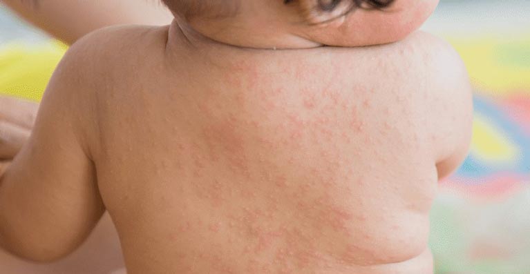 Dr. Yeung Ho Hong(楊浩康) explains Roseola infantum