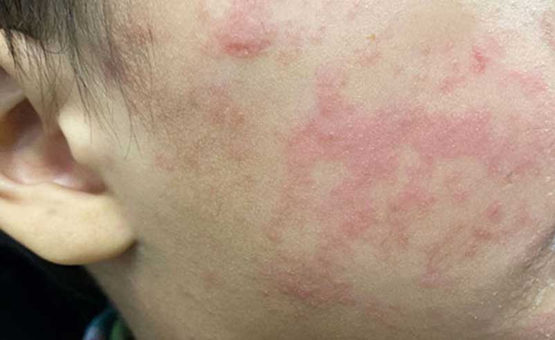 Dr. Yeung Ho Hong(楊浩康) explains Measles
